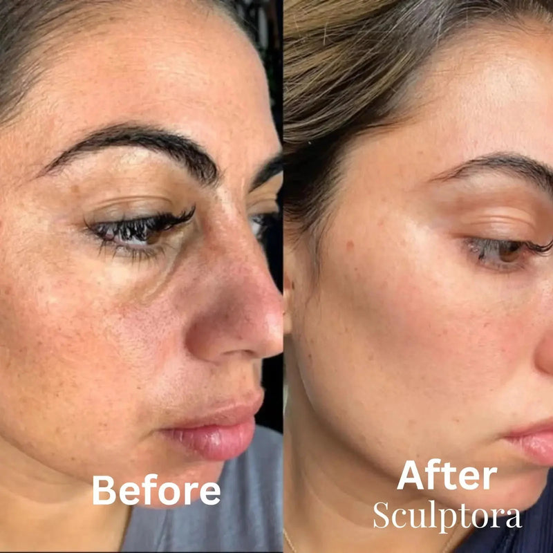 Under-Eye Bags & Puffiness
