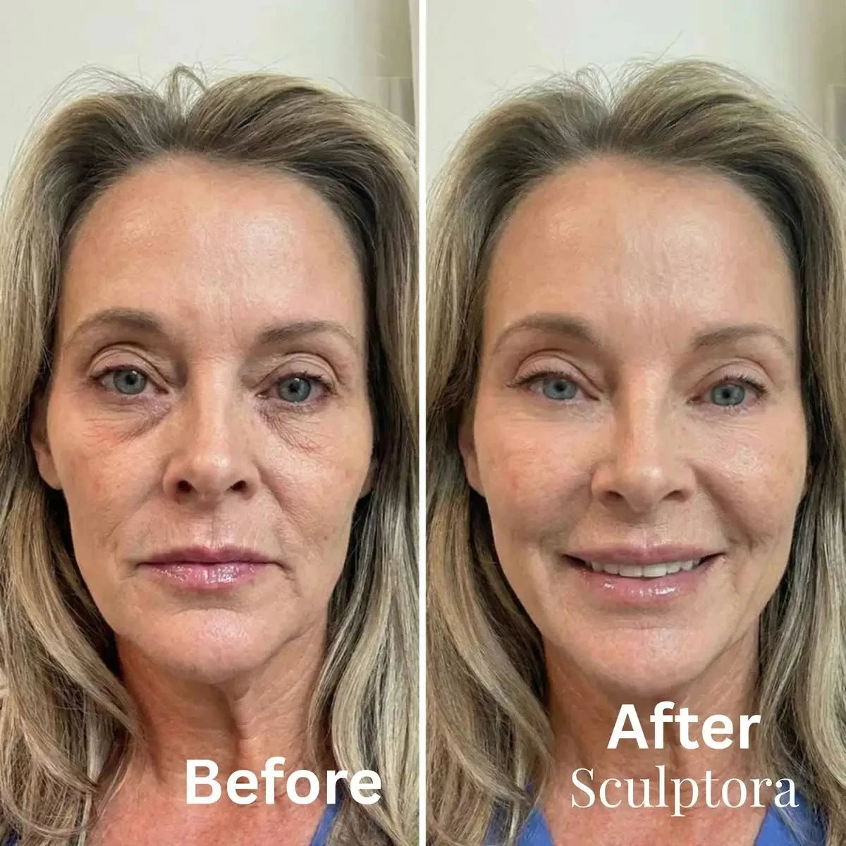 Sculptora Contour™ Pro