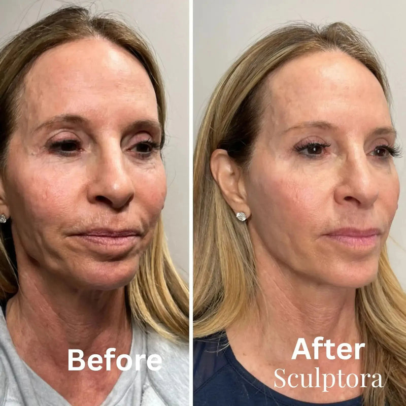 Complete Alternative to Injectables